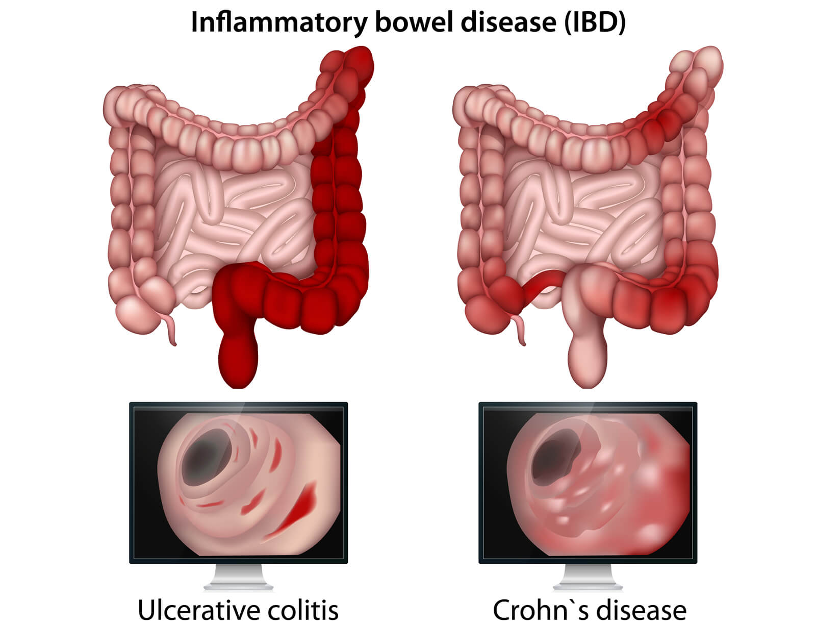 Inflammatory Bowel Disease With Referral From Your Gi Doctor San